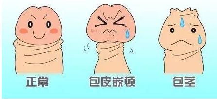 包皮过长要注意哪些